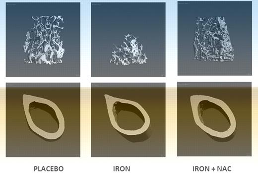 Treatment with an antioxidant prevents the bone loss induced by iron overload. Micro-CT images of placebo, iron dextran, and iron dextran + NAC animals. Trabecular bone at proximal femur and cortical bone at mid-diaphysis femur (image is Figure 4B from Tsay et al1).