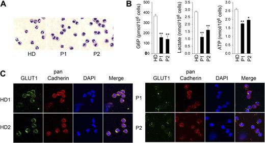 Figure 5. Analysis of levels of G6P, lactate, and ATP in neutrophils of human G6PC3-deficient patients. Annexin V–depleted blood neutrophils were isolated from HD (n = 5; ages 23 to 37 years) and 2 G6PC3-deficient patients, P1 and P2, incubated for 30 minutes at 37°C in glucose-containing RPMI-1640 medium, and G6P, lactate, and ATP were determined as described in “G6P, lactate, and glycogen determination” and “Total ATP determination.” (A) Hema 3-stained cytospins of neutrophils. (B) G6P, lactate, and ATP levels. Data represent the mean ± SEM of 2 independent experiments, each done in duplicates. *P < .05; **P < .005. (C) Representative immunofluorescence of GLUT1 staining (green fluorescence), pan Cadherin membrane staining (red fluorescence), and DAPI nuclei staining (blue fluorescence) at 630× magnification.