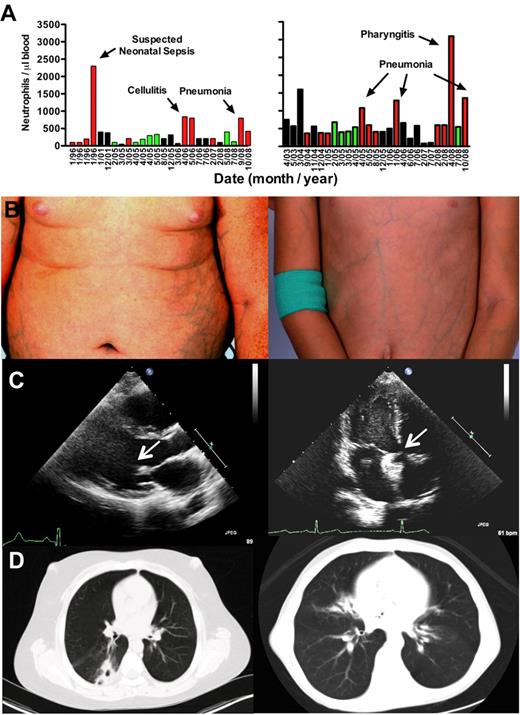 Figure 1. Patient phenotypes: brother (left panels); sister (right panels). (A) Neutropenia. All available absolute neutrophil counts (ANC) values were plotted by date (nonlinear time scale). Neither patient received G-CSF or other hematopoietic growth factors during the period of observation plotted. Green bars represent clinically uninfected; red bars, active clinical infection; and black bars, unknown infection status. (B) Ectatic superficial veins on chest, abdomen, and extremities. (C) Cardiac defects. Echocardiography revealed a thickened and stenotic mitral valve (arrow) with reduced excursion in the brother and a catheter-implanted atrial septal defect occlusion device (arrow) in the sister. (D) Pulmonary infiltrates and bronchiectasis on chest computed tomography.