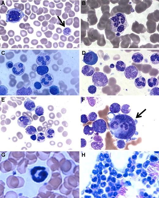 Figure 3. Patient blood and bone marrow histopathology. (A-F) Human data for brother (A,C,E) and sister (B,D,F). Similar results were observed for both siblings. The patient samples shown were obtained before the patients had ever received hematopoietic growth factors and at a time when there was no evidence of active infection. (A-B) Patient peripheral blood smears. (A) Giant platelets (arrow) and vacuolization of monocytes. (B) Rare but morphologically normal neutrophils in the blood. (C-F) Patient bone marrow smears. (C-D) All stages of myeloid differentiation through an abundance of morphologically mature neutrophils are evident. (E) Vacuolization of 2 metamyelocytes. A majority of megakaryocytes were monocytoid (mean, 68%) and frequently (12%) demonstrated penetration by intact cells (emperipolesis) that appeared to be neutrophils (arrow). (G-H) Mouse data in the absence of G-CSF or AMD3100. (G) G6pc3−/− mouse peripheral blood. Morphologically mature neutrophils were evident. (H) G6pc3−/− mouse bone marrow. An abundance of mature neutrophils is evident.
