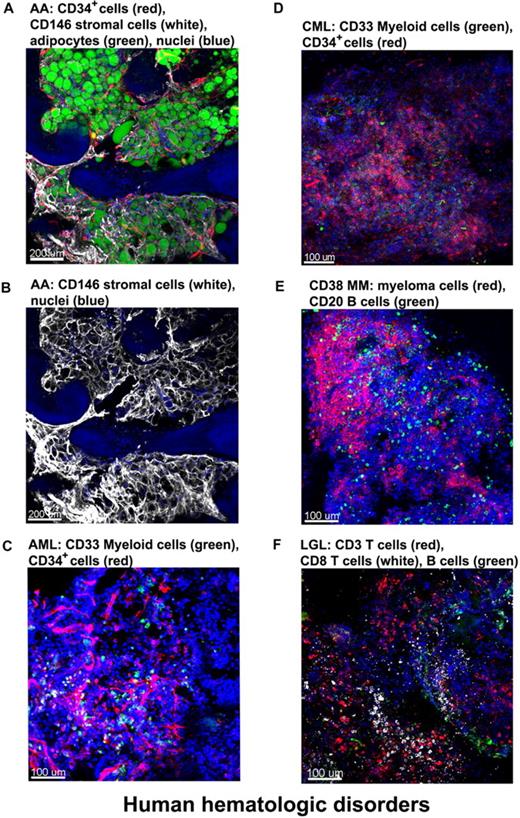 Figure 7. Altered BM architecture in tissues from patients with hematologic diseases. BM whole-mount specimens from patients with hematopoietic disorders were fluorescently stained with cell lineage–specific antibodies and DAPI (nuclei). (A) SAA: most of the hematopoietic space is occupied by adipocytes (green) closely surrounded by almost overlapping vascular (CD34, red) and stromal (CD146, white) network. (B) Same image as in panel A but only the CD146+ staining to clearly display the stromal cell meshwork. (C) AML: both normal and malignant myeloid cells, recognized by anti-CD33 Ab, appear in clusters (green); in addition, an increased number of CD34+ cells (red) appear in close proximity to the endothelial matrix (red). (D) CML-blast crisis: CD34+ leukemic blasts (red) occupy the BM. (E) Multiple myeloma: massive numbers of irregularly shaped malignant CD38+ cells (red), forming a large nodule. (F) T large granular lymphocyte leukemia: sparsely distributed CD8+ cells (white), along with CD3+ cells (red) and sporadic CD20+ B cells (green). Scale bars are in micrometers. Related images appear in supplemental Videos 8 and 9.