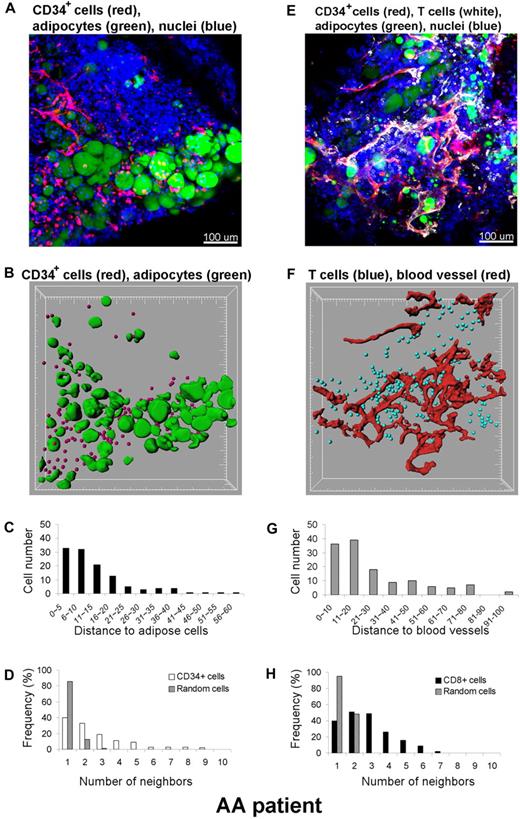 Figure 8. Quantitative analysis of cell distributions in 3 dimensions. A BM specimen from a patient with SAA was fluorescently labeled with antibodies to CD34, CD8, BODIPY 493/503 (adipocytes), and DAPI (nuclei) (A,E). Original confocal images are presented in top panels (A) CD34+ cells (red)/adipocytes (green) and (E) CD8+ cells (white)/blood vessels (red). Bottom panels display segmented images of (B) CD34+ cells (red)/adipocytes (green) and (F) CD8+ cells (blue)/blood vessels (red), computationally extracted from the original fluorescence images, to measure the distance to adipose cells (C) and blood vessels (G), respectively. Clustering of CD34+ cells (D) and of CD8+ cells (H) was analyzed by comparing experimental data (white columns in panel D) and (black columns in panel H) with a Monte Carlo simulation (hatched columns in panels D and H) of randomly distributed cells of same density in a similar volume. Representative images and results from one patient are presented. The analysis was repeated independently 2 to 4 times for 4 different specimens.