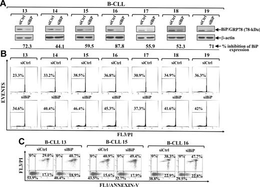Figure 5. Effect of BiP/GRP78 down-regulation on spontaneous B-CLL cell apoptosis. (A-C) Freshly isolated B-CLL cells were transfected with 2.0μM control nontargeting (siCtrl) or BiP/GRP78 siRNA (siBiP) as described in “siRNA nucleofection” and then cultured in complete medium for 72 hours (n = 7). (A) BiP/GRP78 expression was analyzed by Western blot in 20 μg whole-cell lysates, and protein loading was assessed by reprobing the blots with an anti–β-actin mAb. For each sample, blot lanes corresponding to siCtrl and siBiP were subjected to densitometric analysis and normalized to β-actin levels, and values under siBiP lane of each sample represent the percentage inhibition of BiP/GRP78 expression induced by siBiP compared with siCtrl. (B-C) Apoptosis was evaluated by flow cytometric analysis of hypodiploid nuclei (B) and annexin V/PI-stained cells (C). (A-B) Results from all 7 patients examined are shown. (C) Results shown for patients 13, 15, and 16 are the percentage of viable (annexin V−/PI−), early apoptotic (annexin V+/PI−), late apoptotic (annexin V+/PI+), and necrotic cells (annexin V−/PI+).