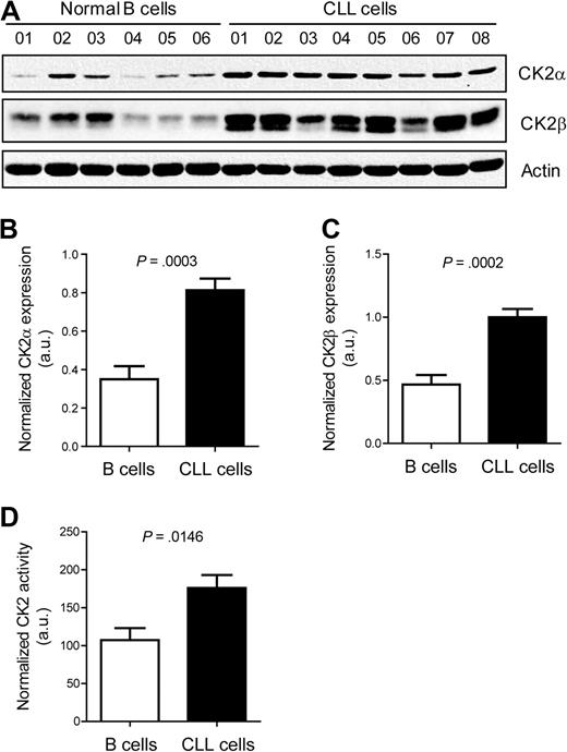 Figure 1. CLL cells display significantly higher CK2 expression and activity than normal B cells. (A) Cell lysates of isolated primary CLL cells collected at diagnosis or isolated normal B cells from healthy donors were resolved by SDS-PAGE and immunoblotted with antibodies against CK2α, CK2β, or actin as loading control. Relative expression of CK2α (B) and CK2β (C) was quantified by densitometry analysis and is expressed in arbitrary units (a.u.). (D) CK2 activity was measured by an in vitro kinase assay in CLL cells (n = 8) and normal B cells (n = 6). Results shown as mean ± SEM.