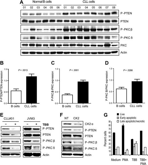 Figure 5. CK2 inhibition-dependent apoptosis of CLL cells correlates with PTEN activation and relies on inactivation of PKC. (A) Cell lysates of normal B cells from healthy donors or primary CLL cells collected at diagnosis were purified and immunoblotted with antibodies against P-PTEN(S380), PTEN, P-PKCβ(S660), P-PKCδ(T550), PKC, or actin as loading control. (B-D) Expression of P-PTEN relative to total PTEN (B) and expression of P-PKCβ (C) and P-PKCδ (D) relative to total PKC was quantified by densitometry analysis. Results are shown as mean ± SEM. (E) Primary CLL cells or JVM-3 cells were incubated with 25μM and 50μM TBB, respectively, and lysed after 2 hours. Cell lysates were immunoblotted with antibodies against the indicated proteins and their phosphorylated forms. P-PTEN results are representative of 10 patients analyzed. P-PKC results are representative of 2 patients analyzed. JVM3 results are representative of 3 independent experiments. (F) MEC1 cells were nucleofected with control versus CK2α siRNA and analyzed at 72 hours for the expression/phosphorylation of the indicated proteins by immunoblot. (G) Primary CLL cells were preincubated with 100nM PMA for 2 hours and then cultured with 12.5μM TBB for 48 hours. Cell viability was assessed by annexin V/7-AAD staining. Results are shown as mean ± SEM of triplicates and are representative of 4 patients analyzed.