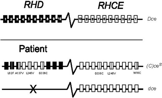 Figure 1. RH genotype of the patient with sickle cell disease. The common RH haplotype Dce is represented by the RHD and RHCE genes, which are homologous, oriented in opposite directions, and comprise 10 exons each (top panel). The patient's genotype harbors the variant (C)ces type 1 and the common dce haplotypes (bottom panel). The variant amino acid substitutions are shown by positions and amino acids involved, relative to the common RH alleles.