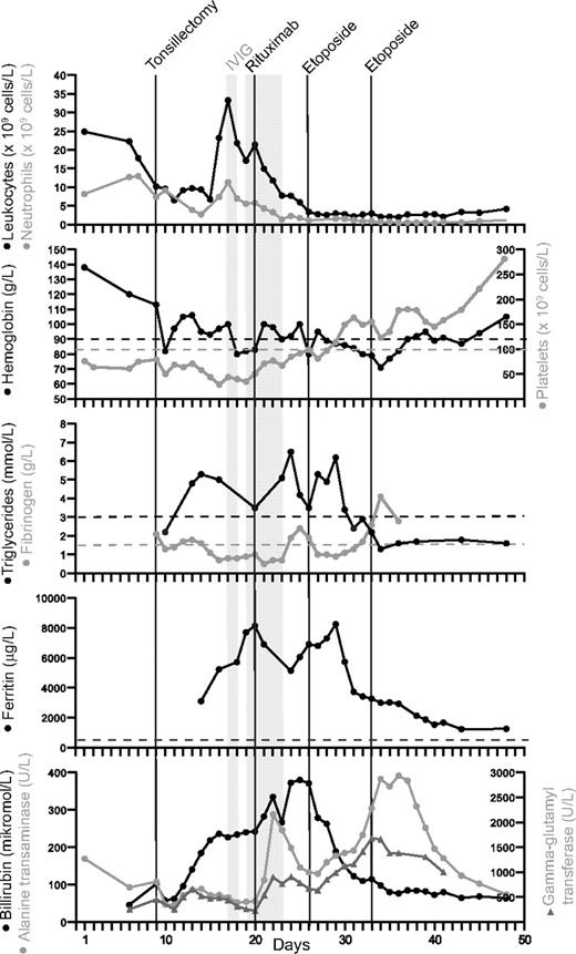 Figure 2. Clinical and laboratory parameters of index case (patient A). Body temperature and laboratory parameters included in the diagnostic criteria for hemophagocytic lymphohistiocytosis (HLH) according to the Histiocyte Society (panels 1-5) and liver parameters (panel 6) are charted for the first 50 days after admission. Black lines indicate tonsillectomy, treatment with rituximab (day 20, 412 mg/m2), and 2 doses of etoposide (days 26 and 33, 100 mg/m2). The shaded area represents days with administrated intravenous immunoglobulin (IVIG; day 17 and days 19-22; 0.17 g/kg and 0.40 g/kg per day, respectively).