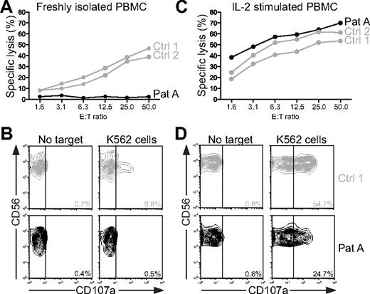 Figure 3. NK-cell cytotoxicity and degranulation in the index case (patient A). (A-B) Resting peripheral blood mononuclear cells (PBMCs) or (C-D) PBMCs stimulated for 72 hours with IL-2 from patient A and 2 healthy adults were evaluated for cytotoxicity and degranulation toward K562 cells. (A,C) Plots show specific lysis for different effector cell to target cell (E:T) ratios in a 4-hour 51Cr-release assay. (B,D) After 2 hours of incubation at 37°C, the cells were stained with fluorochrome-conjugated anti-CD3, anti-CD56, and anti-CD107a monoclonal antibodies. Lymphocytes were gated on forward/side scatter plots, followed by gating on CD3 versus CD56 plots. Plots show CD56 versus CD107a expression on CD3−CD56+ natural killer (NK) cells. The percentage of CD107a+ cells is indicated. NK-cell cytotoxicity and degranulation were analyzed repeatedly in the patient. One representative experiment is shown.