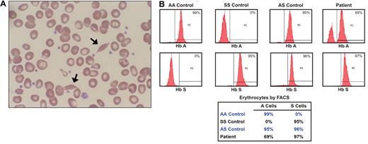 Figure 1. Peripheral smear and FACS analysis results. (A) Wright-stained peripheral smear (original magnification ×100) from the patient with occasional sickle cells (arrows). (B) Results of FACS analysis for Hb A and Hb S in peripheral erythrocytes from the patient and controls with Hb AA, Hb SS, and Hb AS. The propositus' chimerism of 69% AS cells and 31% SS cells is consistent with the 43.2% Hb A and 52.1% Hb S found through hemoglobin HPLC. The small fraction of peripheral blood cells that remain unstained by antibodies to either Hb A or Hb S probably represents nonerythroid cells or erythrocytes that were insufficiently permeabilized to antibody.
