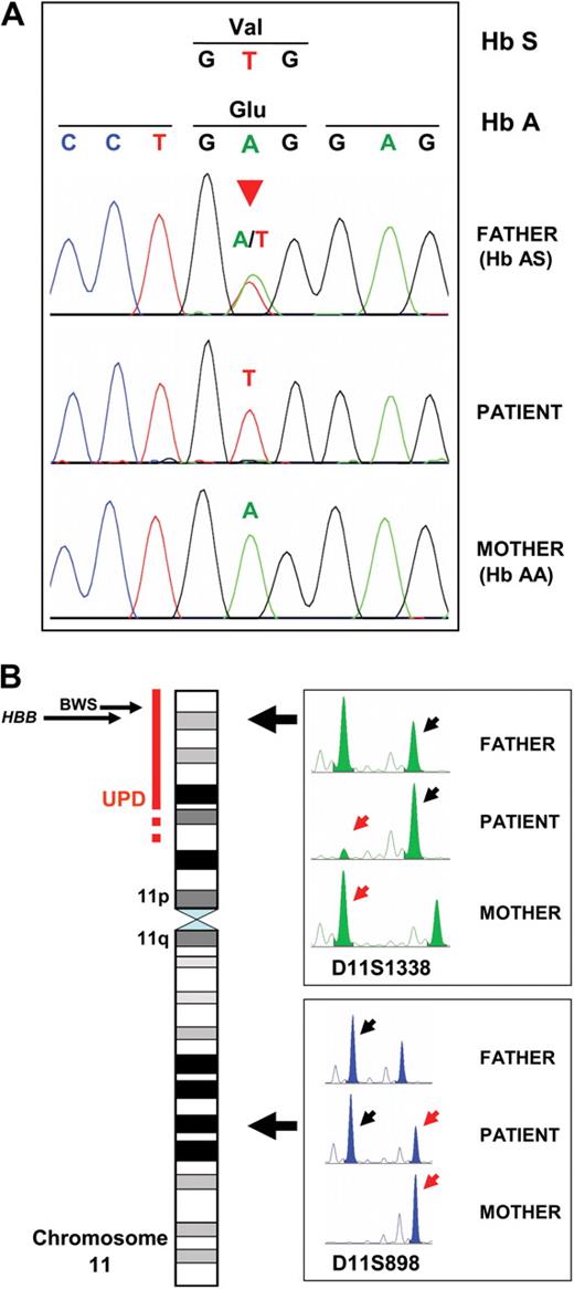 Figure 2. Genotyping results for the patient and his parents. (A) DNA sequencing for the c.20A>T (Hb S) mutation of propositus and parents. The propositus' 8% mosaicism for the wild-type allele (Hb A) was below the detection limit of the assay, and he appeared homozygous Hb SS. The mutation is marked by the red arrowhead. (B) Results of genotyping with chromosome 11 polymorphic STR markers to define the patient's UPD. The region of mosaic UPD is marked by the red bar next to the chromosome 11 ideogram. The dashed portion of the bar represents uncertainty in which the UPD begins. The locations of the HBB gene (11p15.4) and the BWS locus (11p15.5) are marked. The panels at right show electropherograms of 2 STR markers amplified by PCR from leukocyte DNA of the patient and his parents. Large left-facing arrows mark the positions of the markers on chromosome 11. For each marker, small black arrows point to the allele transmitted from the father to the patient, and small red arrows point to the allele transmitted from the mother. D11S898, an STR outside the region of UPD (11q22.1), shows normal biparental inheritance. At D11S1338, within the region of mosaic UPD (11p15.4), the patient has a significantly reduced maternal allele.