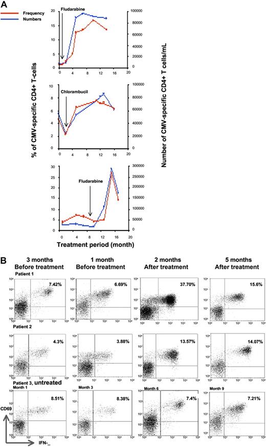 Figure 4. The proportion of CMV-specific CD4+ T cells increases markedly during treatment with chemotherapy. (A) The temporal kinetics of the CMV-specific CD4+ T-cell response was assessed in relation to treatment history. The frequency and absolute number of IFNγ-producing CD4+ T cells increases sharply during treatment with chlorambucil or fludarabine. (B) Examples of the kinetics of the CMV-specific CD4+ T-cell immune response in 3 patients who were studied serially at 3 monthly intervals. Patient 1 showed a stable immune response prior to commencing treatment with fludarabine, after which the CMV-specific CD4+ T-cell response peaked at 37.7% of the CD4+ T-cell pool after 2 months and then declined. Patient 2 received treatment with chlorambucil and also exhibited an increase in the CMV-specific CD 4+ T-cell immune response, which increased up to 5 months after treatment. Patient 3 was untreated and showed a stable CMV-specific immune response. FACS analysis was gated on CD4+ T cells and IFNγ expression is shown on the x-axis and CD69 on the y-axis. The absolute CD4 T-cell counts (cells/μL) were (A) 671, 540, 530, and 642 at 0, 4, 8, and 12 months; (B) 1104, 829, 800, and 983 at 0, 4, 8, and 14 months; and (C) 389, 377, 417, and 97 at 6, 10, 12, and 16 months, respectively.
