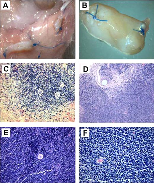 Figure 2. Macroscopic and histologic analysis of ovarian fragments recovered from the mice after 6 months' grafting. (A) Macroscopic view of normal frozen-thawed ovarian grafts. (B) Macroscopic view of an enlarged ovarian graft. Note the stitches at both ends. (C) Histologic aspect of a normal ovarian-xenografted fragment. Five ovarian follicles can be recognized in a cellular stroma surrounded by a fibrotic area. Original magnification ×100. (D) Human ovarian graft from a patient with ALL with massive cellular invasion. Note the 6-0 Prolene stitch in the graft (arrow). Original magnification ×50. (E) Human follicle encircled by a large number of lymphocytes. Normal ovarian stroma is no longer present. Original magnification ×100. (F) Massive lymphocytic invasion of the ovarian graft. The histologic abnormalities observed in these lymphocytes were identified as malignant in nature and attributed to leukemic invasion. Original magnification ×200.