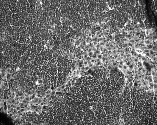 Figure 3. Histologic analysis of murine livers. Histologic aspect of a liver from a mouse developing abdominal masses, with large lymphocytic invasion of the hepatic tissue (case 12). Original magnification ×200.