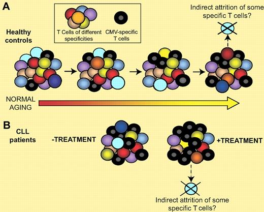 CMV-specific T-cell expansion may constrict the T-cell repertoire. (A) Healthy individuals have diverse repertoire of T cells. In CMV-seropositive healthy individuals, there is a disproportionate accumulation of CMV-specific T cells compared with those of other specificities in young but especially in older subjects.6 (B) CMV-seropositive CLL patients have significantly increased proportions of CMV-specific T cells compared with age-matched controls which is even more striking in those who have received chemotherapy.1 One hypothesis for the increased incidence of infections and decreased survival in both CMV-seropositive CLL patients and older humans is that T cells of other specificities (eg, VZV) may be lost through competition for growth factors and or survival niches in tissues.6–8
