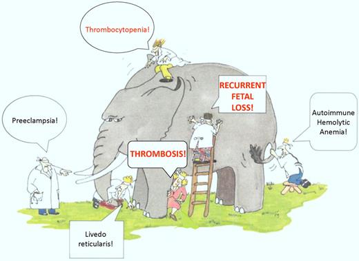 The APS elephant. A sampling of the many clinical manifestations seen in patients with APL, including the Sapporo diagnostic criteria of thrombosis and recurrent fetal loss. Many of these manifestations may be observed in clinical practice in patients with APL, although the strength of their relationship to the APS is uncertain. Thrombocytopenia is a particularly common finding in patients with APL, as demonstrated in the Comellas-Kirkerup study and other reports (adapted figure from Himmelfarb et al,11 Kidney International).