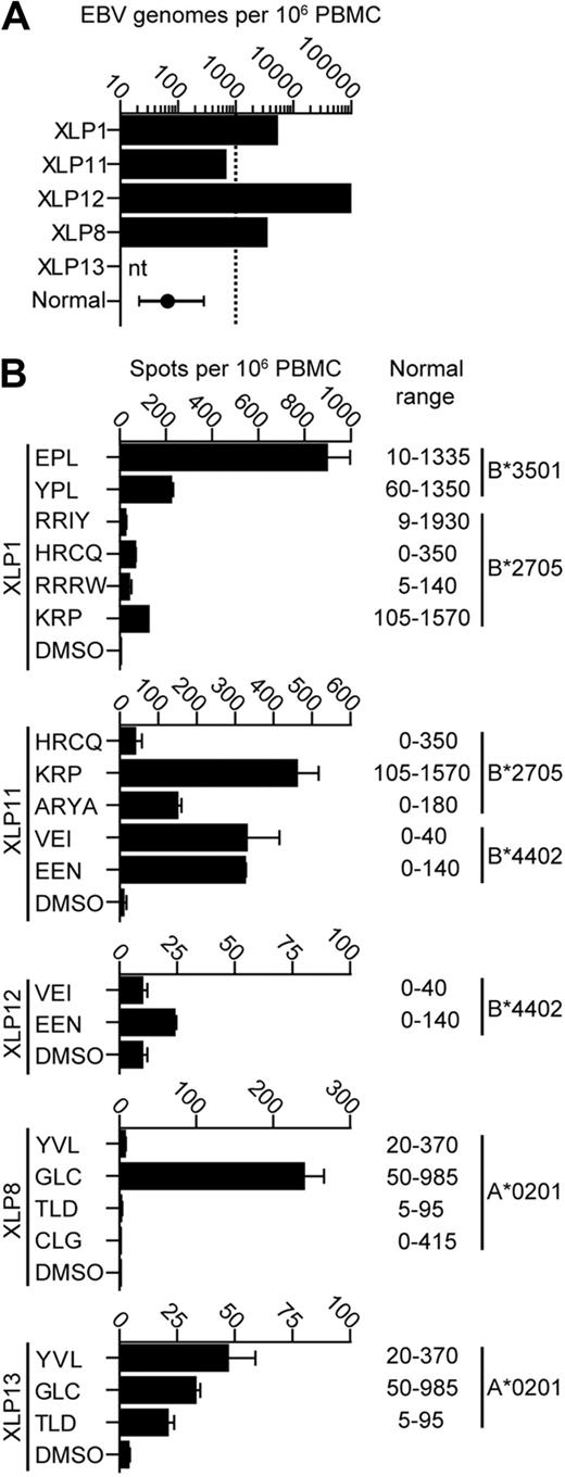 Figure 1. EBV virus loads and EBV-specific CD8+ T-cell responses in PBMCs from 5 XLP patients. (A) EBV genome load in 106 PBMCs was estimated by quantitative polymerase chain reaction analysis. The normal donor value reported represents the median and the 25-75 percentile range of 600 healthy donors, while the dashed line indicates the upper level of the normal range observed in healthy donors. nt indicates not tested. (B) IFN-γ ELISpot analysis of EBV-specific PBMCs taken from 5 XLP donors. PBMCs were stimulated with known immunodominant EBV epitopes appropriate for their HLA type or the peptide solvent dimethyl sulfoxide (DMSO)as a control. Normal ranges of responses from healthy donors are shown.