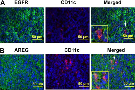 Figure 6. Tumor-associated DCs express AREG and EGFR. (A) Tumor-associated CD11c+ cells express EGFR. Immunofluorescence analysis demonstrated that cells stained with CD11c (red) are also positive for EGFR (green) within tumor sections. Nuclei are stained with Hoechst (blue). Arrows point to CD11c and EGFR–double positive cells (40×/0.75 NA objective). (B) Tumor-associated CD11c+ cells express AREG. Immunofluorescence analysis demonstrated that cells stained with CD11c (red) are also positive for AREG (green) within tumor sections. Nuclei are stained with Hoechst (blue). Arrows point to CD11c and AREG–double positive cells (40×/0.75 NA objective).
