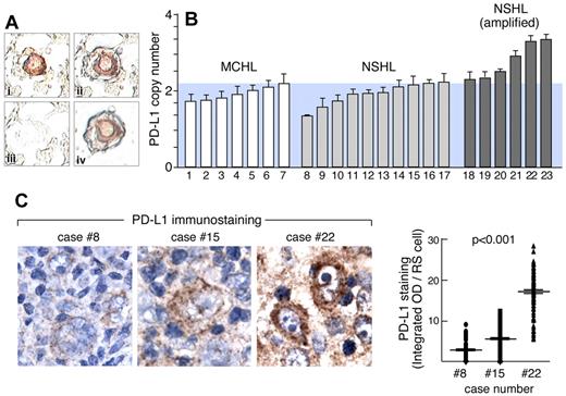 Figure 3. PD-1 ligand amplification and overexpression in primary HL. (A) Laser-capture microdissection (LCM) of primary HL Reed-Sternberg RS cells. (Ai) RS cells were identified by CD30 staining, (Aii) selected by laser (Arcturus PixCell II), (Aiii) removed from surrounding nonneoplastic tissue, resulting in (Aiv) highly enriched RS cell specimens. (B) qPCR-based DNA copy number analysis of PD-L1 in LCM primary RS cells isolated from 7 MCHLs and 16 NSHLs. Data are means (± SD) of triplicate qPCR reactions performed on pooled DNA samples from RS cells or normal tissue from each slide, repeated for 3 slides per sample. (C left) Quantitative IHC of PD-L1 in 3 representative cases (8, 15, and 22) from panel B. (C right) Quantitative analysis of PD-L1 immunostaining in 150 individual RS cells from each of these cases (8, 15, and 22).