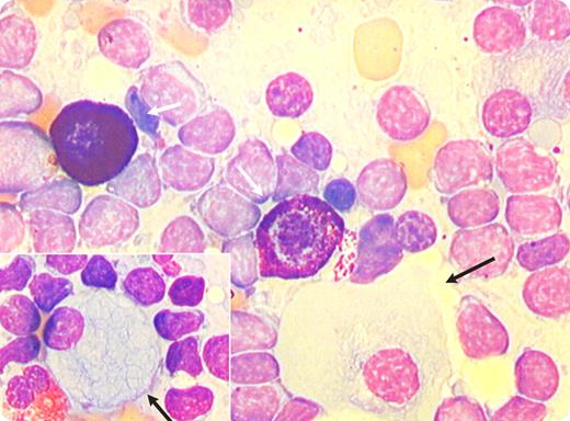 A 76-year-old woman presented with monoclonal immunoglobulin M (IgM) κ protein (20.9 g/L) and slight lymphocytosis (6000/μL). A bone marrow examination showed marked infiltration with pleiomorphic B-lineage cells at different stages of maturation, such as small lymphocytes, lymphoplasmacytoid cells, and plasma cells. B cells were positive for IgM and pan–B-cell markers, and negative for CD5, CD3, CD10, CD23, and CD43. A significant increase in the number of mast cells was noted (white arrows). The marrow also contained many cells with light microscopic morphology resembling Gaucher cells (black arrows). In this clinical context, these cells were considered to be pseudo-Gaucher cells. / A diagnosis was made of Waldenström macroglobulinemia (WM), a B-cell malignancy characterized by an IgM monoclonal gammopathy and BM infiltration with lymphoplasmacytic cells (LPCs). Excess mast cells are commonly present in WM and may provide growth and survival signals to LPCs. / Pseudo-Gaucher cells have occasionally been described in various hematologic malignancies including multiple myeloma, myelodysplastic syndrome, lymphomas, thalassemia, and chronic myelogenous leukemia. This phenomenon can be related to a relative deficiency in glucocerebrosidase because of the excessive catabolism of cell membranes associated with high turnover of malignant hematopoietic cells. However, this hypothesis has not been confirmed, and its pathophysiology remains obscure because hematophagocytosis is only rarely associated with pseudo-Gaucher cells, and ceramide molecules do not make fibrils with typical electronic microscopy morphology. Alternatively, this phenomenon may be related to crystallization of monoclonal immunoglobulins, in which case they can even be considered as pseudo–pseudo-Gaucher cells.
