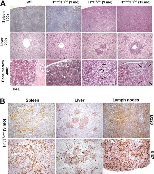 Figure 6. Histologic analysis of WT, nonleukemic Hwt/wt/Ttg/wt (9 months old), leukemic H−/−/Ttg/wt mice (9 months old), and leukemic Hwt/wt/Ttg/wt (15 months old). (A) Histopathologic examination of lymphoid tissues: in comparison with WT Hwt/wt/Ttg/wt mice (9 months old) showed an early, interfollicular effacement of splenic architecture by medium-sized lymphoid cells that almost completely replaced splenic tissue in Hwt/wt/Ttg/wt (15 months old) and H−/−/Ttg/wt (9 months old) mice. Liver involvement with roughly similar degree of infiltration was noted only in Hwt/wt/Ttg/wt (15 months old) and H−/−/Ttg/wt (9 months old) mice. Areas of BM infiltration by neoplastic lymphocytes, shown by arrows, were restricted to leukemic H−/−/Ttg/wt (9 months old) and Hwt/wt/Ttg/wt (15 months old) mice (hematoxylin-eosin stained sections; 100× magnification for spleen, 200× for liver; 400× for bone marrow). (B) Immunohistochemical stains showed that in H−/−/Ttg/wt mice (9 months old) the majority of leukemic infiltrates in spleen, liver, and mesenteric lymph nodes was B220+ (top panel). The lower panel highlights the different replicative fraction in the evaluated organs, according to Ki-67 immunostaining (200×). Images were acquired with an Axioscop 40 microscope (Zeiss) equipped with an Axiocam MRC camera (Zeiss).