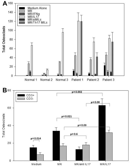 Figure 3. IL-17–producing MILs increase osteoclastogenesis. (A) BM from normal donors and myeloma patients was incubated for 21 days in medium alone, macrophage colony-stimulating factor and RANKL (MR), MR plus IFN-γ, or MR plus IL-17. Myeloma BM was also incubated with MR plus autologous aMILs (Th1 skewed cells), or MR plus autologous Th17 skewed MILs. OC colonies were scored on day 21 by staining with 23-C6. Data are representative of 10 patients. (B) OC formation is T cell dependent. Ficolled BM from myeloma patients were either CD3 depleted or left unmanipulated and incubated for 21 days in medium alone or with the addition of MR, IL-17, MR/IL-17, MR plus anti–IL-17, or anti–IL-17. Cells were stained with 23-C6 and OCs were scored.