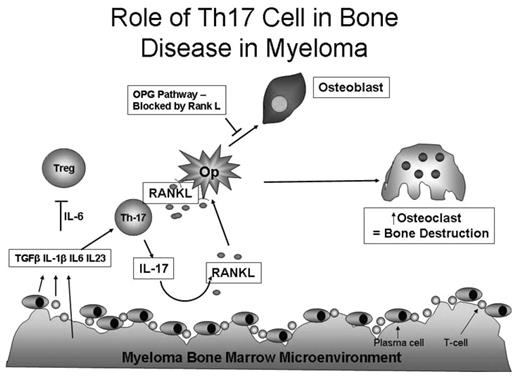 Figure 5. Proposed model of the role of IL-17–producing MILs in myeloma bone disease. The tumor microenvironment, consisting of plasma cells, stromal elements, and MILs, produces IL-6, TGF-β, IL-1β, and IL-23. The excess of IL-6 compared with TGF-β causes a shift from a Treg (predominantly found in a normal BM) to a Th17 cell, which in turn increases T-cell production of IL-17 and RANKL. These 2 cytokines together with MIP-1α subsequently act on OC precursors (Op) to increase osteoclastogenesis. The addition of IFN-γ–producing T cells inhibits osteoclastogenesis.