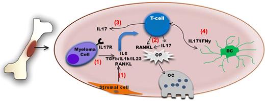Schematic diagram summarizing the role of IL-17–producing lymphocytes in bone disease in myeloma. The bone and the bone marrow are immunologically active sites. (1) Myeloma cell–stromal interaction leads to up-regulation of factors such as IL-6, TGF-β, IL-1β, IL-23, and RANKL The first 2 factors in particular will induce IL-17–producing lymphocytes which also express RANKL. (2) Both factors in turn will act upon osteoclast precursors (Op) and increase osteoclast generation and/or activity. (3) IL-17 also increases adherence of myeloma cells expressing IL17R to BM stromal elements by functioning as a myeloma growth factor. (4) Dendritic cells might also contribute to the induction of Th17 cells in the BM of myeloma patients.