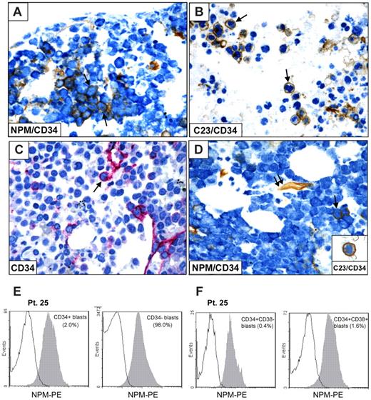 Figure 3. CD34+ cells in NPM1-mutated AML show cytoplasmic expression of nucleophosmin. (A-B) CD34+ leukemic cells (brown) from a patient with NPM1-mutated AML showing cytoplasmic expression of NPM (blue; A arrows) and nucleus-restricted positivity for C23/nucleolin (B arrows). (C-D) Another NPM1-mutated patient showing rare CD34+ cells (C) that double stain for CD34 (brown) and cytoplasmic NPM (blue; D single arrow); endothelium of a vessel express CD34 (D double arrow). CD34+ leukemic cell (brown) from the same case show nucleus-restricted positivity for C23/nucleolin (blue; D inset). (A-B,D) Sequential immunoperoxidase/APAAP staining; no counterstaining. (C) APAAP technique (hematoxylin counterstaining). (A-D) Paraffin sections from bone marrow biopsies. All images were collected using an Olympus B61 microscope and a UPlan FI 100×/1.3 NA oil objective; Camedia 4040, Dp_soft Version 3.2; and Adobe Photoshop 7.0. (E-F) Flow cytometric detection of NPM-cytoplasmic expression (patient 25) in CD34+ and CD34− blasts (E), and after additional gating on CD34+/CD38− or CD34+/CD38+ cells, respectively (F).