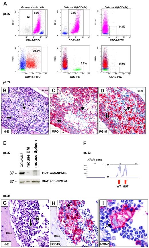 Figure 6. Patterns of engraftment of CD34− cells from NPM1-mutated AML in immunodeficient mice. (A-F) Example of engraftment (pattern 3) in NOG mice inoculated with 10 × 106 CD34− cells (purity 99.9%) from patient 22. (A) Flow cytometric analysis of bone marrow (6 weeks after inoculum) showing engraftment of human myeloid (93% hCD45+/CD33+) cells, which appeared CD34− (0.3% CD34+ cells) and CD11b+ (70.8% hCD45+/CD11b+). A small percentage of T cells (5.9% hCD45+/CD3+) was also detected. (B-D) Tibia paraffin sections showing massive marrow infiltration by a double population: (1) mononuclear cells close to bone trabeculae (B double arrows; inset, from a different section), which are MPO+ and PGM1(CD68)+ (C-D double arrows); (2) mature histiocytes located in the central area of bone marrow (B single arrow), which are MPO− and PGM1+ (C-D single arrows). Asterisk in panel B inset and in panel C indicates bone area. (E-F) Leukemic origin of these cells was confirmed by WB with anti-NPM mutant (anti-NPMm) antibody (E) and genomic DNA fragment analysis showing double peaks (F). (G-I) Example of engraftment (pattern 4) in NOG mice inoculated 6 weeks before with 2 × 106 CD34− cells (purity 99.99%) isolated from patient 21. Tibia paraffin sections showing marrow infiltration by a mixed population of mature histiocytes (single arrow) and lymphocytes (double arrows). Immunostaining for hCD45 confirmed the human origin of these cells. (B,G) Hematoxylin and eosin. (C-D,H-I) APAAP; hematoxylin counterstaining. Images were collected using an Olympus B61 microscope and a UPlanApo 40×/0.85 (B-D,G-H) and a UPlan FI 100×/1.3 NA oil objective (B inset, I); Olympus E330-ADU1.2× camera; and Adobe Photoshop 7.0.