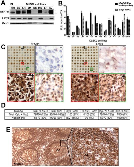 Figure 1. Correlation of NFATc1 and c-myc protein expression in B-cell lymphomas. (A) Nuclear extracts (25 μg) were purified from a Burkitt lymphoma cell lines (Ramos) and 7 DLBCL cell lines (BJAB,LR, McA, DS, MS, LP, and EJ) and analyzed for expression of NFATc1, c-myc, and Oct-1 (protein loading control) proteins by Western blotting. *, **, and *** denote hyperphosphorylated, phosphorylated, and dephosporylated NFATc1 protein bands, respectively. (B) Purified RNA and nuclear extracts from representative DLBCL cell lines were analyzed for c-myc mRNA expression and for NFATc1 DNA binding, respectively. DS, negative for both c-myc and NFATc1, was used as a baseline negative control. Values indicate fold-induction over DS from triplicate samples of 2 independent experiments. SU4, SUDHL-4; LY10, OCI-LY10. P for NFATc1 DNA binding versus c-myc mRNA for all cell lines was determined by the Student t test (P = .166; R2 = 0.07246). (C) TMA of DLBCL (100 cases) for NFATc1 and c-myc protein expressions by immunohistochemistry. Representative high-magnification (×200) TMA sections from DLBCL biopsy cores that are negative (−, black box), moderate (+, green box) or high (++, red box) immunostaining for NFATc1 and c-myc (side panels). (D) Analysis for NFATc1 and c-myc protein expression in DLBCL TMA (100 cases), using 30% cutoff. (E) Immunostaining for NFATc1 in reactive lymph node section. GC, germinal center (×100; ×400).