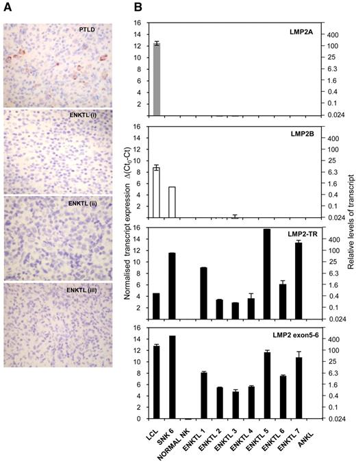 Figure 7. LMP2-TR, but not LMP2A or LMP2B, are expressed in primary ENKTL tissue. (A) Immunohistochemistry of formalin-fixed, paraffin-embedded tissue sections with antibody clone 15F9, specific for LMP2A. Images were captured with a Nikon Coolpix E995 digital camera, via a Nikon Eclipse E400 microscope (optical magnification × 400). A case of EBV+ B cell PTLD is a positive control. Sections from 3 representative cases ENKTL (i-iii of 7) shown. (B) Quantitative RT-PCR data using cDNA derived from 7 primary ENKTL tissue biopsies and 1 EBV+ aggressive NK leukemia sample. QRT-PCR assays were performed to detect conventional LMP2A and LMP2B, LMP2-TR and transcripts containing exon 5-6 splice; the latter representing total LMP2 mRNAs. Ct0 represents the assay threshold of detection. LMP2 transcript Ct values are normalized to cellular GAPDH Ct values. The left-hand y-axis represents Δ(Ct0-Ct), while the right-hand axis shows the equivalent fold difference in transcript levels. Note: input cDNA was 2 μL in a reaction volume of 20 μL, compared with 5 μL in 25 μL for the cell line PCR studies for Figures 5 and 6.