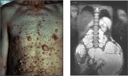 Figure 1. Examples of cutaneous and plexiform neurofibromas. Cutaneous neurofibromas growing on the chest and abdomen and an magnetic resonance image of a large plexiform neurofibroma compressing the spinal column. Photographs courtesy of the Children's Tumor Foundation; www.ctf.org.