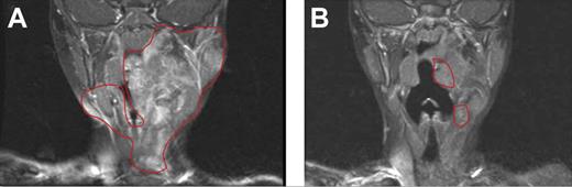 Figure 6. Evaluation of imatinib mesylate efficacy in an index patient with a plexiform neurofibroma. Coronal magnetic resonance imaging scans (T1-weighted images with gadolinium contrast and fat saturation) of the head and oropharynx of a patient with NF1 patient with a plexiform neurofibroma before (A) and 3 months after (B) treatment with imatinib mesylate. The region of the tumor in the respective images is indicated. Reprinted from Yang et al23 with permission from Elsevier.