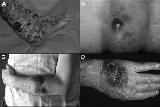 Figure 1. Clinical presentation of the patients. (A) Widespread ulcerated nodular lesions over the right leg (case 2); (B) erythematous-violaceous nodule on the arm at the onset (case 4); (C) plaques and nodules with ulceration and hemorrhagic aspects on the left arm (case 5); (D) nodular-ulcerative lesions localized on the left hand (case 3).