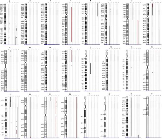 Figure 4. Chromosomal ideograms of genomic alterations detected by array CGH. Region of loss are indicated by bold lines on the left of each ideogram, and the lines on the right represent regions of gain. Genomic alterations of case 3 (ENK/T-N) are underlined with red.