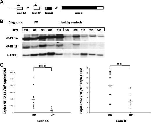 Figure 1. Relative abundance of the alternatively transcribed NF-E2 mRNA isoforms 1A and 1F in PV patients and healthy controls. (A) Schematic diagram of the human NF-E2 genomic locus. Two alterative promoters, 1A and 1F, are present, transcribing noncoding exons 1A or 1F, respectively. Both NF-E2 mRNA isoforms share exons 2 and 3, which contain the ORF (indicated in black). (B) Northern blot analysis of exon 1A– or exon 1F–containing NF-E2 mRNA expression in PV patients and healthy controls. Total RNA from purified peripheral blood granulocytes was probed with cDNA fragments specific for Exon 1A (top) or 1F (middle), respectively. A cDNA fragment of the GAPDH gene was used a RNA loading control (bottom). (C) Quantitation of NF-E2 Exon 1A (left) and Exon 1F (right) expression in PV patients and healthy controls. RNA was isolated from purified granulocytes of 10 PV patients as well 9 healthy controls (HC) and subjected to quantitative RT-PCR analysis for NF-E2 exon 1A and exon 1F expression. A standard curve with known copy numbers of the 2 NF-E2 exons and β-2-microglobulin (B2M) was included on each plate. Sample copy numbers of each NF-E2 exon and β-2-microglobulin were determined from the standard curve and are expressed as relative ratios (copy number NF-E2 exon per 103 B2M molecules). The median is depicted by a horizontal line; **P < .01, ***P < .001 by t test.