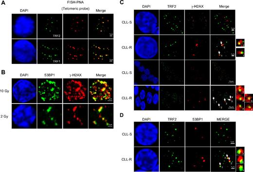 Figure 2. Quantification of TIF in CLL cells according to their in vitro sensitivity to apoptosis. (A) FISH with a telomere-specific (C3TA2)3–Cy3-labeled peptide nucleic acid probe (PNA; red fluorescence) and immunostaining of TRF2 or TRF1 used to control for the telomere position in the interphase nuclei of CLL cells. (B) Double immunostaining of γ-H2AX and 53BP1 in CLL cells after 2 Gy or 10 Gy irradiations used to label DNA DSBs in interphase nuclei. (C) Double immunostaining of γ-H2AX and TRF2 in CLL-R and CLL-S cells. Arrows indicate the γ-H2AX/TRF2 colocalizations. (D) Double immunostaining of 53BP1 and TRF2. Their colocalization is indicated by arrows. (E) Double immunostaining of γ-H2AX and TRF1. Their colocalization is indicated by arrows. (F) Comparisons of γ-H2AX/TRF2-positive cells between CLL-S and CLL-R. Positivity was assigned when more than or equal to 50% γ-H2AX foci colocalized with TRF2 in one cell. Bars represent the mean percentage ± SD. (G) Comparison of 53BP1/TRF2-positive cells between CLL-S and CLL-R. Bars represent the mean percentage ± SD. (H) Comparison of γ-H2AX/TRF1–positive cells between CLL-S and CLL-R and comparison of γ-H2AX–positive cells between γ-H2AX/TRF2 and γ-H2AX/TRF1 in CLL-S and CLL-R. Bars represent the mean percentage ± SD. The Mann-Whitney U test was used to assess statistical significance: *P < .01; ***P < .001