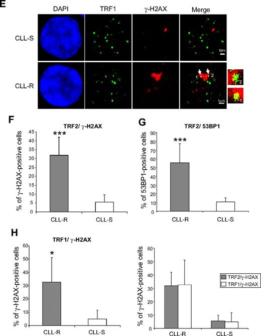 Figure 2. Quantification of TIF in CLL cells according to their in vitro sensitivity to apoptosis. (A) FISH with a telomere-specific (C3TA2)3–Cy3-labeled peptide nucleic acid probe (PNA; red fluorescence) and immunostaining of TRF2 or TRF1 used to control for the telomere position in the interphase nuclei of CLL cells. (B) Double immunostaining of γ-H2AX and 53BP1 in CLL cells after 2 Gy or 10 Gy irradiations used to label DNA DSBs in interphase nuclei. (C) Double immunostaining of γ-H2AX and TRF2 in CLL-R and CLL-S cells. Arrows indicate the γ-H2AX/TRF2 colocalizations. (D) Double immunostaining of 53BP1 and TRF2. Their colocalization is indicated by arrows. (E) Double immunostaining of γ-H2AX and TRF1. Their colocalization is indicated by arrows. (F) Comparisons of γ-H2AX/TRF2-positive cells between CLL-S and CLL-R. Positivity was assigned when more than or equal to 50% γ-H2AX foci colocalized with TRF2 in one cell. Bars represent the mean percentage ± SD. (G) Comparison of 53BP1/TRF2-positive cells between CLL-S and CLL-R. Bars represent the mean percentage ± SD. (H) Comparison of γ-H2AX/TRF1–positive cells between CLL-S and CLL-R and comparison of γ-H2AX–positive cells between γ-H2AX/TRF2 and γ-H2AX/TRF1 in CLL-S and CLL-R. Bars represent the mean percentage ± SD. The Mann-Whitney U test was used to assess statistical significance: *P < .01; ***P < .001