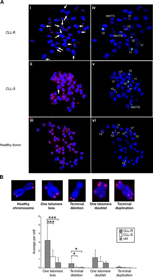 Figure 4. Chromosomal aberrations and telomere dysfunction in CLL cells according to their in vitro sensitivity to apoptosis. (Ai-iii) Representative examples of CLL cells in metaphase from CLL-R (Ai), CLL-S (Aii), and healthy B cells from healthy donors (Aiii). Telomeres are labeled with a telomere-specific (C3TA2)3–Cy3-labeled peptide nucleic acid probe (PNA; red fluorescence). Chromosomes are counterstained with DAPI (blue). Arrows indicate the sites of genomic aberrations resulting from telomere dysfunction. (Aiv-vi) De novo labeling of the metaphase cells shown in panels Ai-iii with CLL multicolor probes to detect chromosomes 11, 12, 13, and 17 and specific chromosomal aberrations therein. Chromosome 11 is labeled green on region 11q22–23. Chromosome 12 is labeled green on centromeric sequences. Chromosome 13 is labeled aqua on region 13q34 and red on region 13q14. Chromosome 17 is labeled red on region 17p13. der indicates abnormal chromosome (derivated). In these cases, this mark shows events of deletions. (B) Representative examples of chromosomal aberrations at the telomeres in CLL cells. Comparison of the average number of telomeric aberrations between CLL-R, CLL-S, and B cell samples from healthy donor controls. Bars represent the mean ± SD. (C) Comparison of the average number of telomeric aberrations and other defined chromosomal aberrations in CLL cell samples. Ctrl indicates control (healthy donors); del 11q22, 11q22 deletion; del 13q14+, 13q14 deletion associated with del 11q22 or del 17p13 detected by FISH; and complex karyotype, karyotype with more than or equal to 3 chromosomal aberrations. Bars represent the mean ± SD. (D) Comparison of average number of telomeric aberrations between 2 CLL cell subclones from the same patient (CLL-12). One subclone has a 13q14 deletion alone, whereas the second has both a 13q14 and 11q22 deletion. ctrl indicates cells from healthy donors. Bars represent the mean ± SD. The Mann-Whitney U test was used to assess statistical significance: *P < .01; ***P < .001