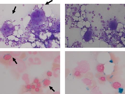 Figure 2. Cytomorphology. Left panel: Bone marrow aspirate of case 1 before treatment of lenalidomide. Right panel: bone marrow aspirate of case 1 after treatment of lenalidomide. The May-Grünwald-Giemsa staining (top) illustrates the disappearance of atypical megakaryocytes with large hyperlobulated nuclei; the iron staining (bottom) illustrates the disappearance of ring sideroblasts after treatment with lenalidomide. A Leica DMLB2 microscope with a Leica DC500 camera and DC TWAIN software was used to make the photograph (40× and 100× objectives).
