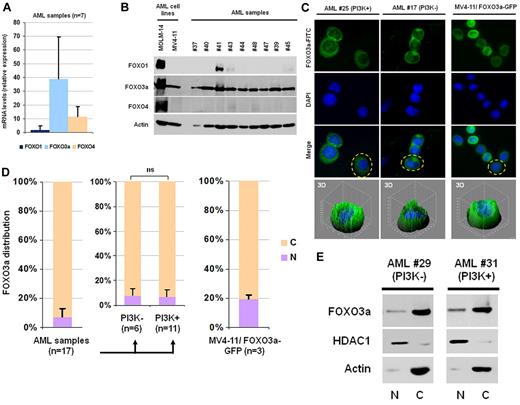 Figure 1. FOXO3a is the prevalent active FOXO in AML blast cells. (A) BM blast cells from 7 patients were highly purified by flow cytometric cell sorting according to CD45low expression and side scatter. FOXO1, FOXO3a, and FOXO4 mRNA levels were quantified by RT-qPCR. Their levels were expressed relative to HPRT mRNA level. (B) Expression of FOXO1, FOXO3a, and FOXO4 in total cell lysates from 9 AML samples was compared with human leukemic cell lines (MOLM-14 and MV4-11). Protein extracts from 106 cells were analyzed by Western blot. (C) FOXO3a localization in AML cells from 17 different AML samples was investigated using IF staining (green: FOXO3a; blue: nuclear DAPI). Images obtained from representative patients 17 and 25 are presented. FOXO3a localization in MV4-11/FOXO3a-GFP cells was investigated by direct analysis of subcellular GFP distribution. Three-dimensional image of the fluorescence intensity of indicated cell is reported. (D) For the quantification of the percentage of cells with nuclear FOXO3a, 100 cells were counted. The statistical significance was calculated by Student t test, and vertical bars indicate SDs. (E) Primary AML blast cells from patients 290 and 31 were subjected to cellular fractionation. Protein extracts from 106 cells were analyzed by Western blot. N and C indicate nuclear and cytoplasmic fraction, respectively.