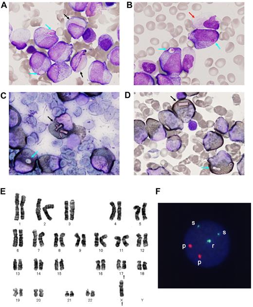 Figure 1. Morphology and cytogenetic analysis of a bone marrow sample of t(X;17)(p11;q12) APL. Leukemic promyelocytes before treatment. (A-B) May-Giemsa staining. (C) Sudan black B staining. (D) Myeloperoxidase staining. Original magnification ×400 for all panels. The black, blue, and red arrows show rectangular cytoplasmic bodies, round inclusions, and Auer-like bodies, respectively. (E) Karyotype analysis. 45,−Y,t(X;17)(p11;q12) was detected in 95% of the cells. (F) FISH analysis. One of the RARA signals is split as (s). Other intact signals of RARA and PML are shown as (r) and (p), respectively.