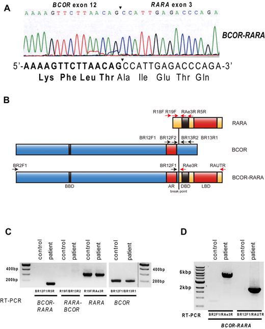 Figure 2. Molecular analysis of the BCOR-RARA fusion transcript. (A) Sequence analysis of the BCOR-RARA transcript at the junction site. The junction of the BCOR and RARA transcripts is indicated by a bold arrowhead. Rearrangement between BCOR exon 12 and RARA exon 3 resulting in an in-frame BCOR-RARA fusion protein. The DNA and amino acid sequences spanning the junction of the BCOR and RARA genes (in bold and normal characters, respectively) are shown below. (B) Schematic diagram of RARA, BCOR, and the BCOR-RARA fusion protein. The break point is indicated by the black line. Primer locations for RT-PCR are shown as arrows. Domains of BCOR-RARA are indicated as follows: BCOR BCL6-binding domain (BBD), ankyrin repeats (AR), DNA-binding domain (DBD), and ligand-binding domain (LBD). (C) RT-PCR analysis of BCOR-RARA fusion transcripts. BCOR-RARA transcripts were detected in cDNA derived from the patient's bone marrow cells on diagnosis, which also contained normal cells with intact BCOR. The control was cDNA derived from EOL1. Primer pairs are shown in the lower lane. A vertical line was inserted to indicate a repositioned gel lane. (D) Long-distance RT-PCR of BCOR-RARA transcripts. No alternative splicing variant was detected.