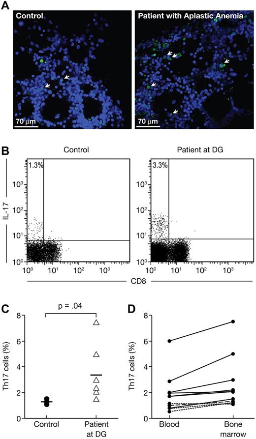 Figure 1. Increased frequencies of Th17 cells in the BM of aplastic patients (AA) at diagnosis. BM from 2 patients (1 moderate and 1 severe AA) and 1 healthy control were stained with 4,6-diamidino-2-phenylindole and anti-IL-17 and then analyzed using confocal microscopy. BMMCs from healthy controls (n = 4) and AA patients at diagnosis (n = 7) were stained with anti-CD3 and anti-CD8 antibodies followed by intracellular staining with anti-IL-17 antibody. Cells were analyzed by flow cytometry after stimulation for 6 hours with PMA and ionomycin in the presence of monensin. (A) Representative confocal analysis of the BM from healthy control (top panel) and AA patient (bottom panel). (B) Representative flow cytometric analysis of IL-17 expressions in CD8− T-cell subsets (Th17 cells) in healthy control (left panel) as well as in AA at diagnosis (right panel). The mean value of each group is indicated. (C) Frequencies of Th17 cells in healthy controls (●, n = 4) and in AA at diagnosis (▵, n = 7). The mean value of each group is represented (solid line). (D) Correlation between the frequencies of PBMC and BMMC Th17 cells in AA at diagnosis (n = 7). Normal donors (4 healthy controls) are represented by a dashed line.