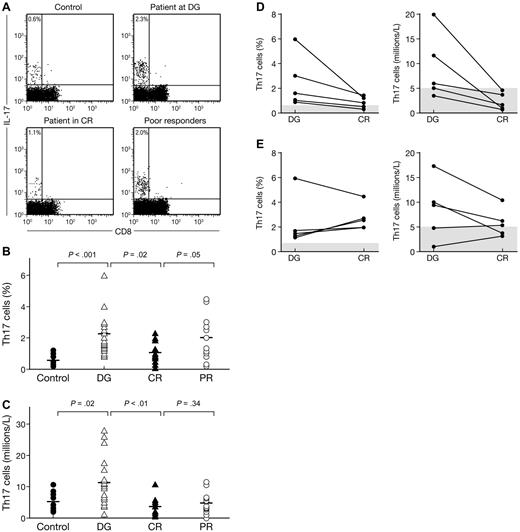 Figure 2. Frequencies and numbers of Th17 cells in aplastic patients (AA) correlate with disease activity. PBMCs from healthy controls (n = 10) and AA patients (AA) at diagnosis (n = 18), in CR (n = 12) or in PRs (n = 12) were stained with anti-CD3 and anti-CD8 antibodies followed by intracellular IL-17 antibody and examined by flow cytometry after stimulation for 6 hours with PMA and ionomycin. (A) Representative flow cytometric analysis of IL-17 expression in CD8− T-cell subsets (Th17 cells) in healthy control (left panel) as well as in AA at diagnosis (left middle panel), in CR (right middle panel), or in PR (right panel). The mean value of each group is indicated. (B) Frequencies of Th17 cells in healthy controls (●) and in AA at diagnosis (▵), in CR (▴) and in PR (○). The mean value of each group is represented (solid line). (C) Absolute numbers of Th17 cells in healthy controls (●) and in AA at diagnosis (▵), in CR (▴) and in PR (○). The mean value of each group is represented (solid line). (D) Frequencies (left panel) and absolute numbers (right panel) of Th17 cells in patients who obtained a CR. Normal values are indicated by gray bars. (E) Frequencies (left panel) and absolute numbers (right panel) of Th17 cells in patients who were PRs. Normal values are indicated by gray bars.