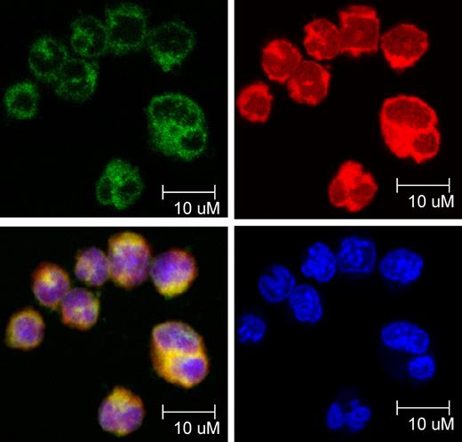 Figure 3. Nanoliposomal-C6 ceramide delivery resulted in the preferential accumulation of C6 in the mitochondria in leukemic NK cells. Confocal microscopic image of 25μM nanoliposomal-NBD-C6 delivery to RNK16, a rat NK LGL leukemia cell line, showing that NBD-C6 (green) colocalized with cellular mitochondria (red); Cellular nucleus was stained with 4′,6-diamidino-2-phenylindole (blue). Magnification, 63×.