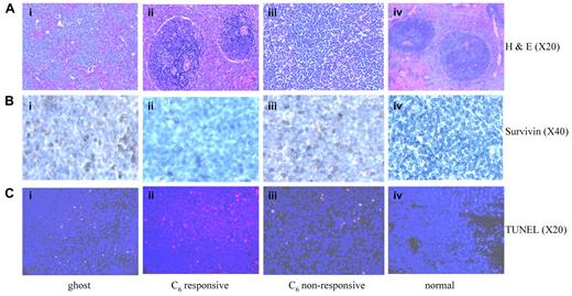 Figure 6. Elimination of leukemic infiltration associated with decreased survivin expression and induction of apoptosis in spleens of leukemic rats responsive to nanoliposomal C6 ceramide. Images were taken from hematoxylin and eosin or immunohistochemically stained 5-μm paraffin sections of rat spleen tissues and analyzed with Olympus 1 × 51 Microscope (Olympus America) attached to Spot Insight Camera (Diagnostic Instruments). The software for imaging and analyses was SPOT Advanced Plus Imaging software. (A) Spleen sections from rats treated with ghost nanoliposome (Ai); with C6 ceramide nanoliposome, responsive (Aii), or nonresponsive (Aiii); and from normal control rat (Aiv) were stained with hematoxylin and eosin. (B) Spleen sections from rats treated with ghost nanoliposome (Bi); from C6-ceramide nanoliposome responsive (Bii), or nonresponsive (Biii); and from normal control rat (Biv) were stained with anti-survivin antibody (D-8; Santa Cruz Biotechnology). (C) Spleen sections were stained with an In Situ Cell Death Detection kit to assess the degree of cellular apoptosis via TUNEL-TMR red staining (red); 4′,6-diamidino-2-phenylindole-stained nuclei (blue). Spleen sections from rats responsive to nanoliposomal-C6 (Cii) showed more positive TUNEL staining than sections obtained from rats treated with ghost nanoliposome (Ci), from rats not responding to C6-ceramide nanoliposome (Ciii) and from normal control rat (Civ).