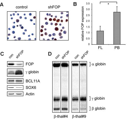 Figure 2. Reduced FOP expression correlates with high HbF in primary human cells. (A) Immunohistochemistry for γ-globin shows that more than 90% of FOP knockdown cells contribute to elevated HbF levels. (B) PB HEP cells express FOP at approximately 2.5 times higher level than FL cells. The level of FOP protein relative to actin; 3 FL and 3 PB donors were analyzed. *Significant difference (Mann-Whitney test, P < .05). (C) Reduced levels of FOP lower the expression of SOX6 but do not change the expression of BCL11A. (D) Quantitative S1 nuclease protection assay demonstrates an approximately 50% increase of γ-globin expression in erythroid progenitors from β-thalassemic patients when FOP levels are reduced.