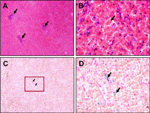 Figure 3. Histologic examination of the patient's spleen. (A-B) Hematoxylin and eosin staining. Original magnifications ×25 (A) and ×400 (B). The red pulp is highly congestive and the white pulp is atrophic, with a marked reduction of the periarteriolar lymphoid sheaths (arrows in panel A). The splenic cords are packed with agglutinated RBCs (arrow in panel B). (C-D) Perls iron staining. Original magnification ×100 (C) and ×400 (D). Very few hemosiderin-containing macrophages are observed (arrows).