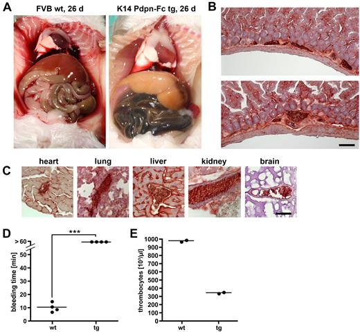 Figure 6. Podoplanin-Fc induces disseminated intravascular coagulation, leading to thrombocyte consumption and bleeding diathesis. (A) A transgenic mouse was examined postmortem after spontaneous death and compared with a wild-type littermate at an age of 26 days. Melena, pale liver, and serosa suggest bleeding to the intestine. (B-C) Embolized blood vessels were observed on cryosections of intestine (B) and other organs (C) of transgenic mice, immunohistochemically stained for human podoplanin. (D) Times until the cessation of bleeding after tail clipping of wild-type and transgenic mice were measured. *** P < .001. (E) Thrombocyte counts in the blood of wild-type and transgenic mice were determined. Bars represent 100 μm (B) and 25 μm (C). wt wild-type; tg transgenic.